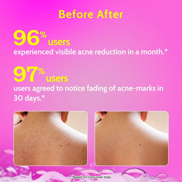 Salicylic Acid Body Wash for Acne Control - 236 ml