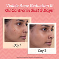 2% Salicylic Acid Face Serum With Lactic Acid | For Acne Control - 30 ml