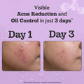 The Clear Skin Duo (2% Salicylic Acid Face Wash - 100 ml | Acne Control Face Serum - 10 ml)