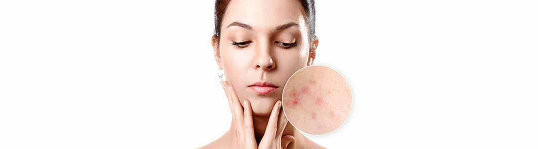 Sunscreen causes acne