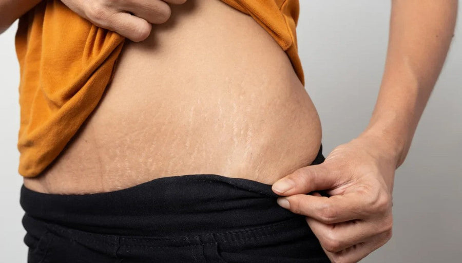 Choosing the Right Stretch Mark Oil: Factors to Consider