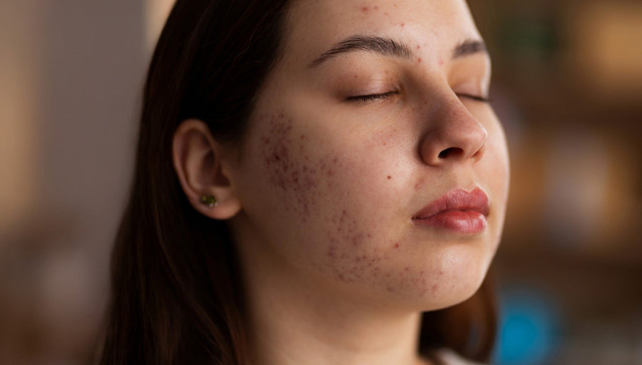 How To Get Rid of Acne Scars and Redness in One Month?