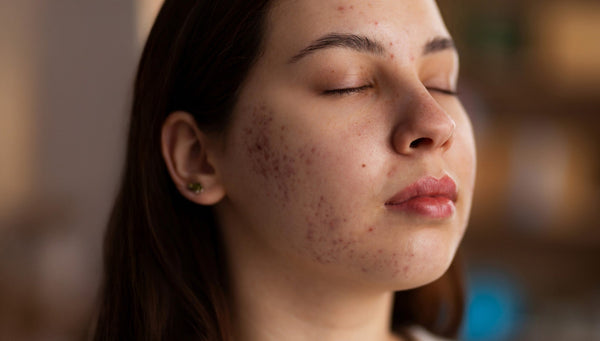 Clear Skin: The Benefits of Using an Acne-Fighting Body Wash
