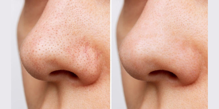 Pores on Your Face: Real Ways to Minimize, Shrink & Tighten Pores