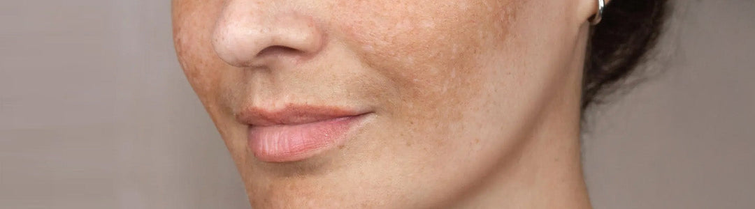 Pigmentation Around Mouth: Causes, Treatment & Prevention Tips