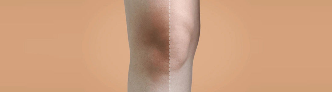 Dark Knees & Elbows: Causes, Treatment & Prevention Tips