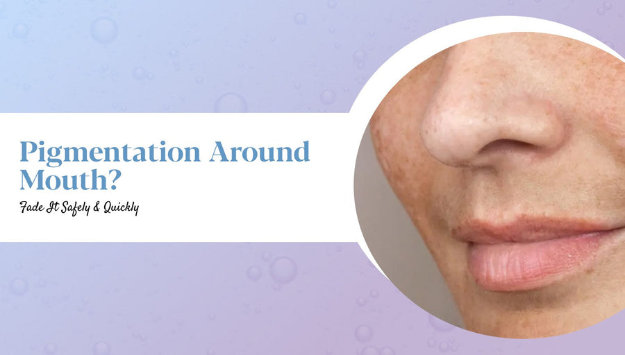 Pigmentation Around Mouth: Causes, Treatment & Prevention Tips