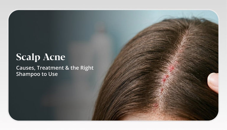 Scalp Acne: Causes, Symptoms & How to Get Rid of Scalp Pimples