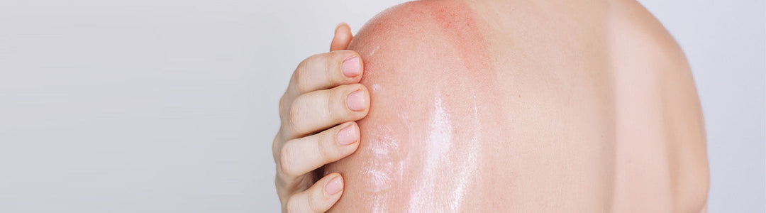 Sunburn in Summers: Causes,Treatment & Prevention Tips