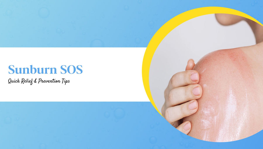 Sunburn in Summers: Causes,Treatment & Prevention Tips