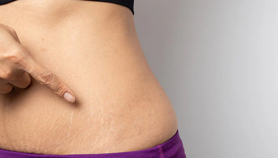 The Benefits of Using Stretch Mark Oil: Nourishing and Hydrating Your Skin