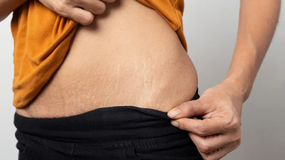 Choosing the Right Stretch Mark Oil: Factors to Consider