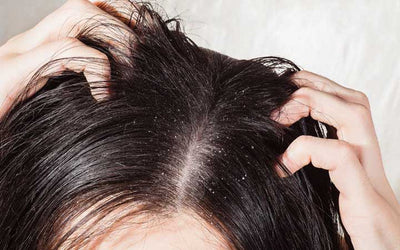 How to Choose the Right Anti-Dandruff Shampoo for Your Hair Type
