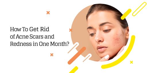 how to get rid of acne scars fast