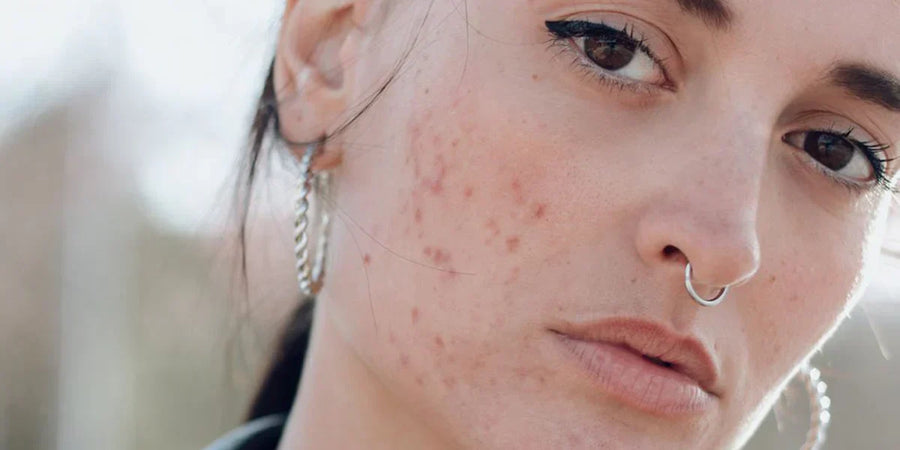 How To Get Rid of Acne Scars and Redness in One Month?