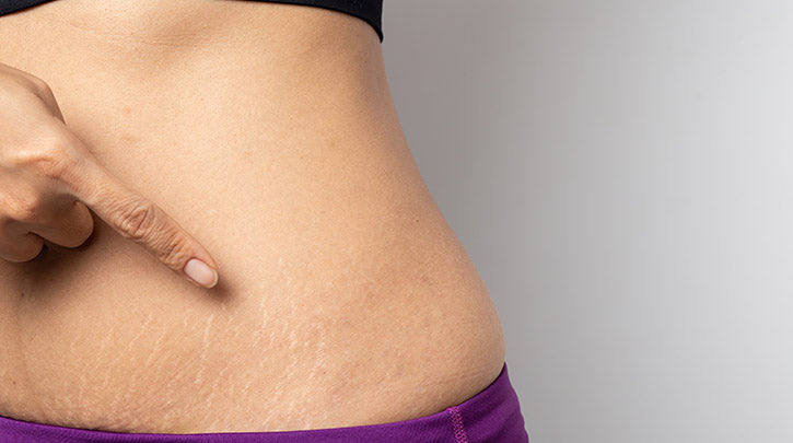 The Benefits of Using Stretch Mark Oil: Nourishing and Hydrating Your Skin