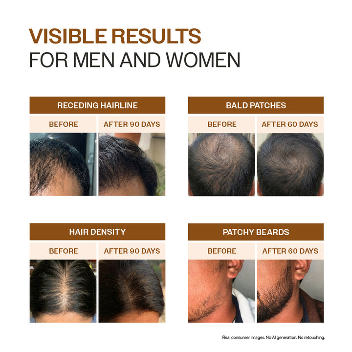 Advanced Hair Growth Serum Spray with 5% Rosemary Extract, 4% Anagain & 3% Redensyl- 30 ml
