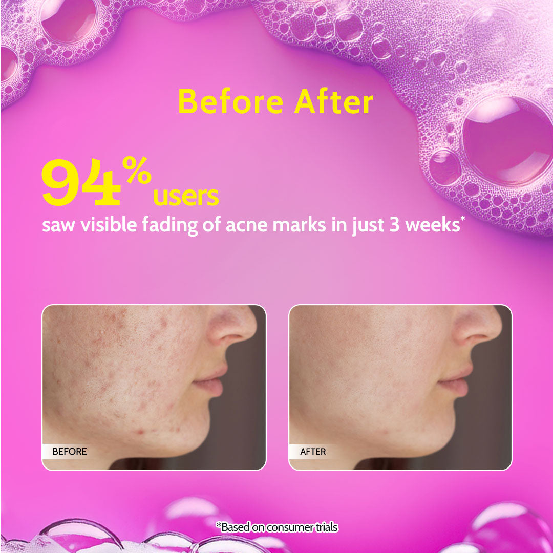 Salicylic Acid Face Wash for Acne & Oil Control- 100ml