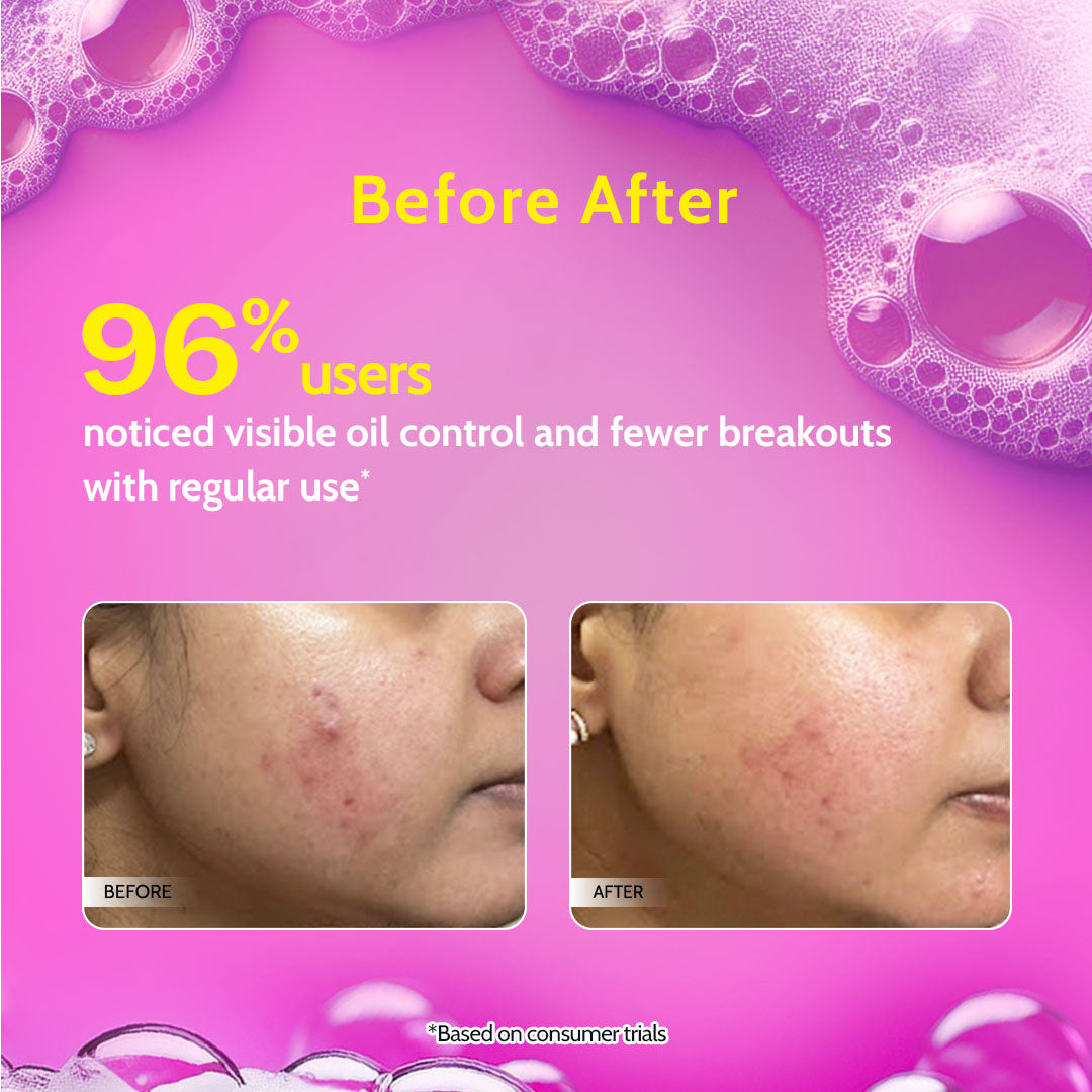 Salicylic Acid Face Wash for Acne & Oil Control- 100ml