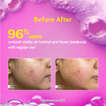2% Salicylic Acid Face Wash for Acne & Oil Control - 100 ml