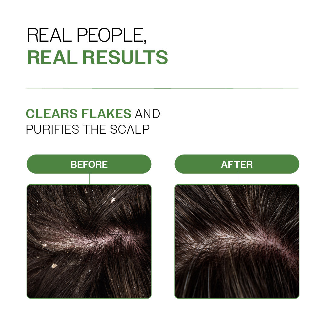 Neem & Lemon Dandruff Control Scalp Spray - 200 ml