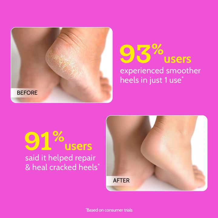 20% Urea Hydrating Foot Roll-On for Cracked Heels & Diabetic Foot - 50 gm