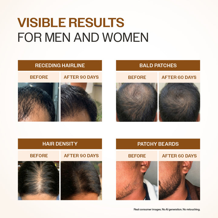 Advanced Hair Growth Serum With 3% Redensyl, 4% Anagain, & 1% Capilia Longa - 30 ml