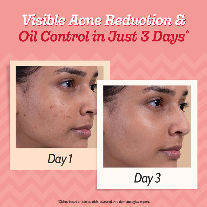 2% Salicylic Acid Face Serum With Lactic Acid | For Acne Control  - 30 ml