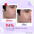 2% Salicylic Acid Face Wash for Acne & Oil Control - 100 ml