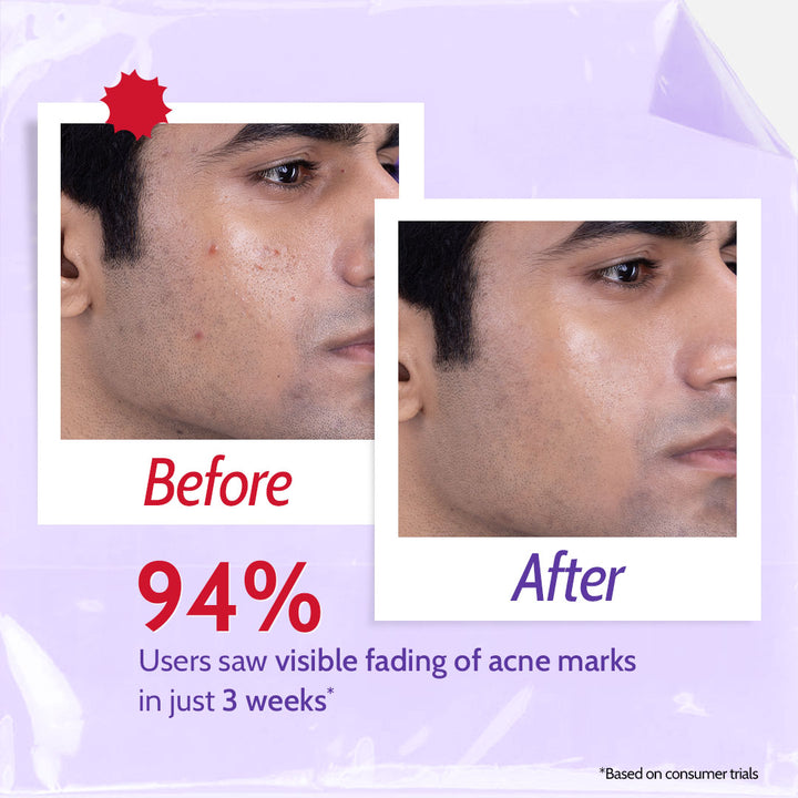 2% Salicylic Acid Face Wash for Acne & Oil Control - 100 ml