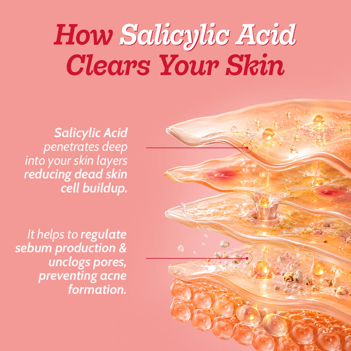 2% Salicylic Acid Face Serum With Lactic Acid | For Acne Control  - 30 ml