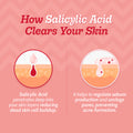 2% Salicylic Acid Face Serum With Lactic Acid | For Acne Control  - 30 ml
