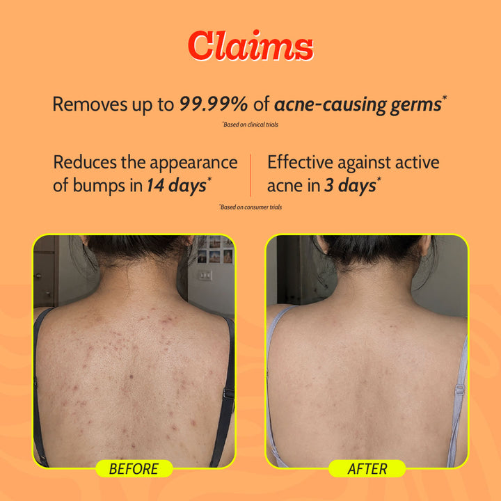 1% Salicylic Acid Body Wash for Body Acne - 236 ml