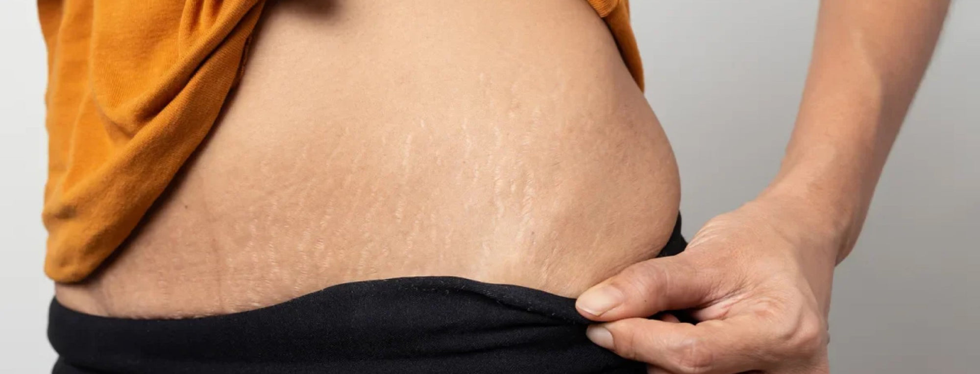 Choosing the Right Stretch Mark Oil: Factors to Consider