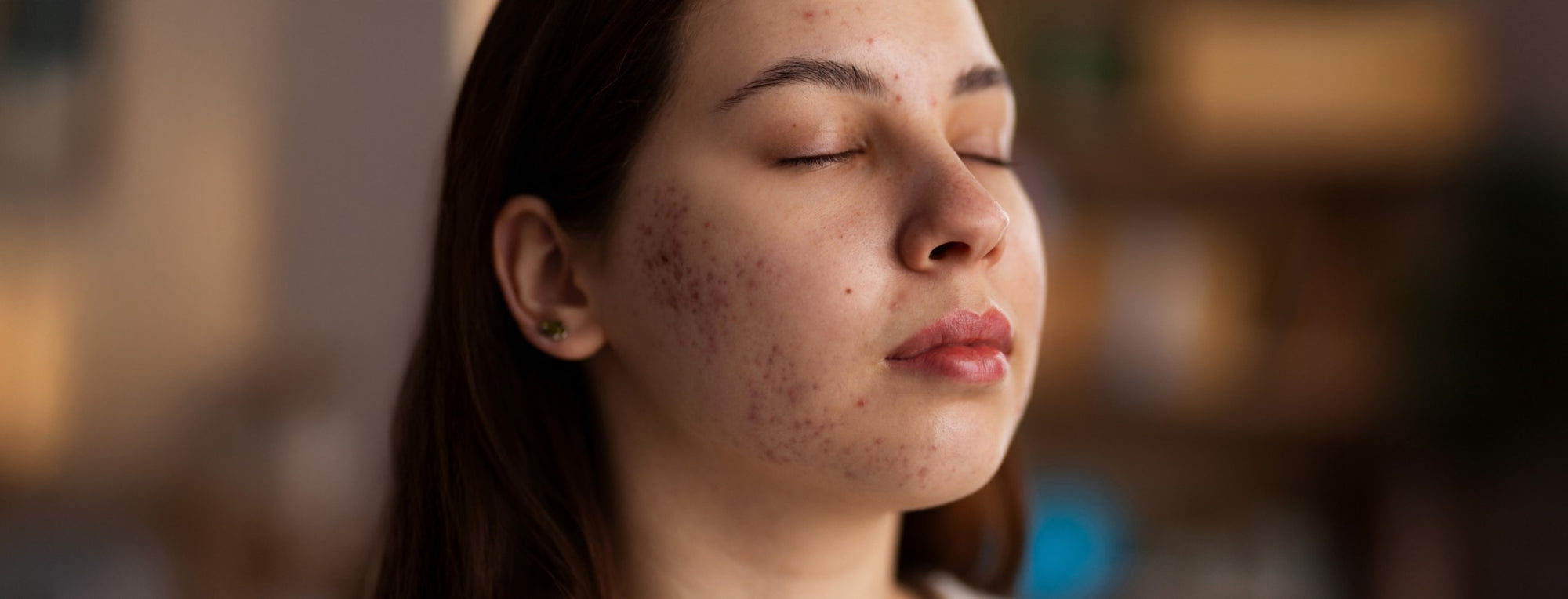 How To Get Rid of Acne Scars and Redness in One Month?