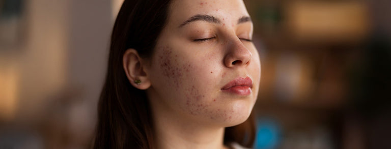 How To Get Rid of Acne Scars and Redness in One Month?