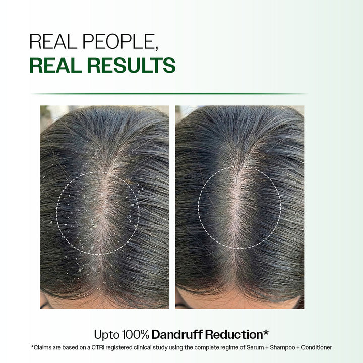 Advanced Anti Dandruff Serum with Salicylic Acid & Pentavitin - 50 ml