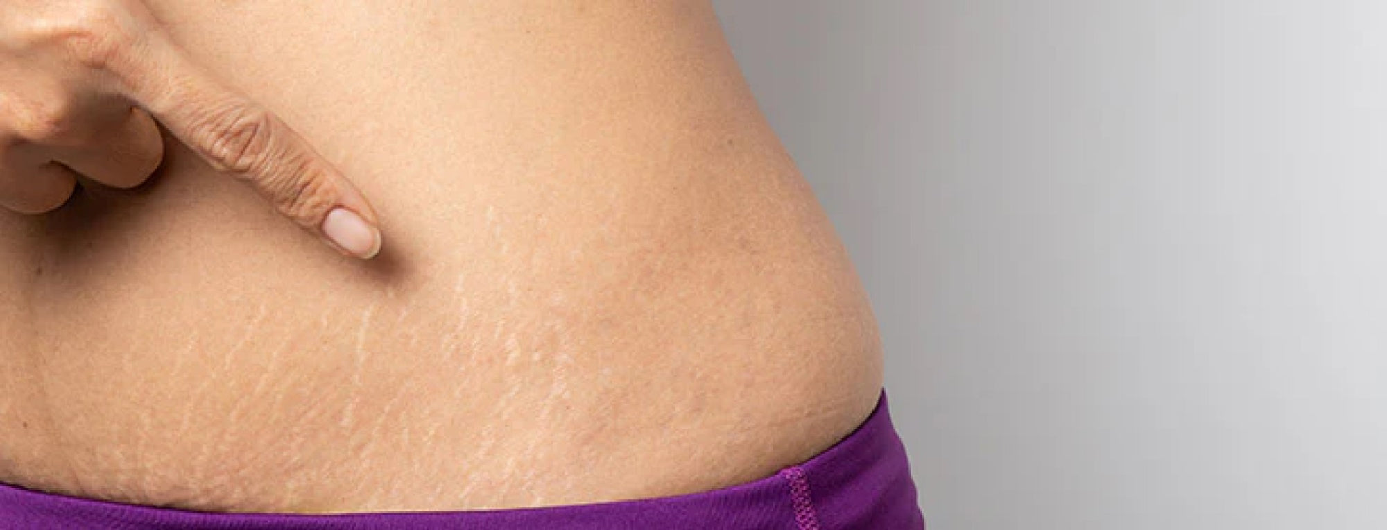 The Benefits of Using Stretch Mark Oil: Nourishing and Hydrating Your Skin